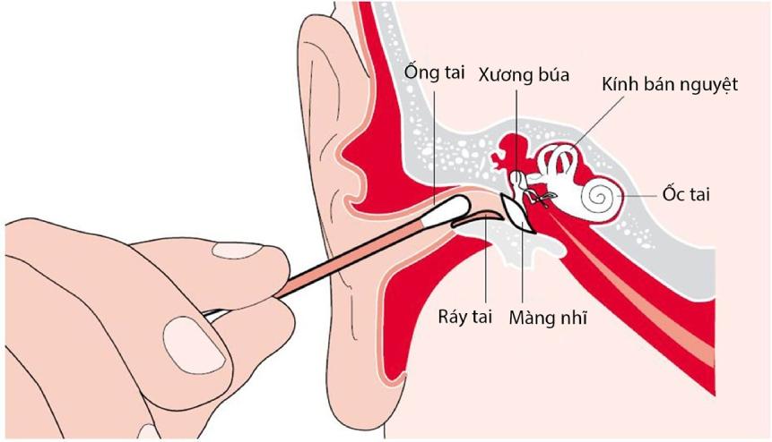 Lắng nghe những lời khuyên bổ ích từ bác sĩ trong việc chăm sóc tai